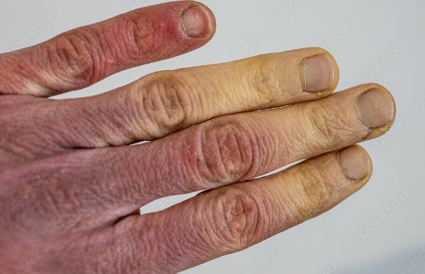 Benefits of Heated Clothing for People with Raynaud's Disease